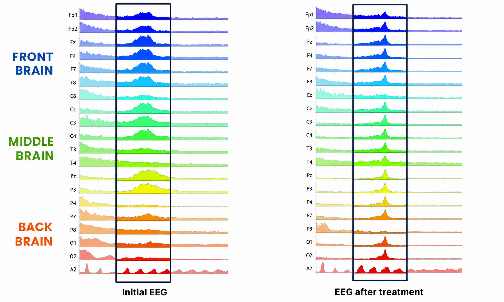 Example EEG recordings shown before and after treatment